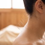 treatment needles inserted into a woman neck in a clinic wellness