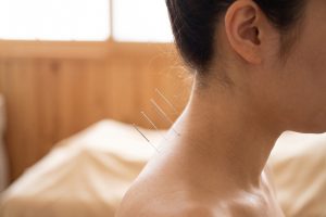 treatment needles inserted into a woman neck in a clinic wellness
